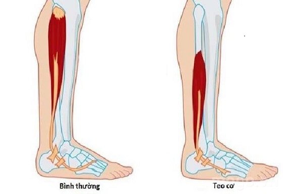 Yếu và teo cơ: ở bàn tay, bàn chân thường xuất hiện đầu tiên